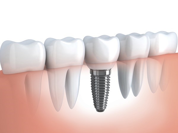 melbourne-dental-implants